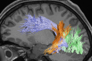 Example of white matter pathways