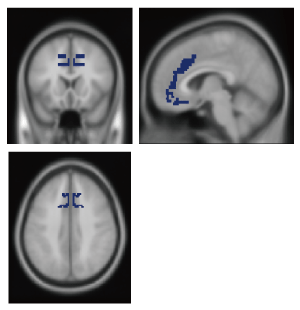 Fig. 2.　Location of the dACC.