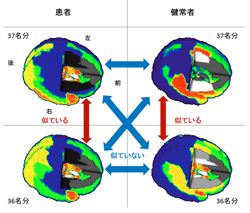 患者群と健常者群の脳部位モジュール解析