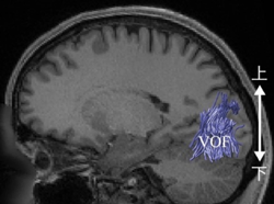 拡散強調MRIデータを基に計測されたヒトのVOF（青線）の例 