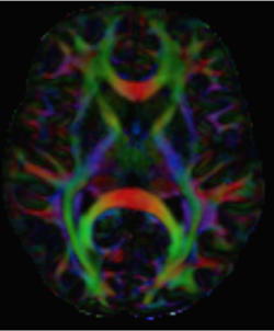 ヒトの脳から計測された拡散強調MRIデータの例