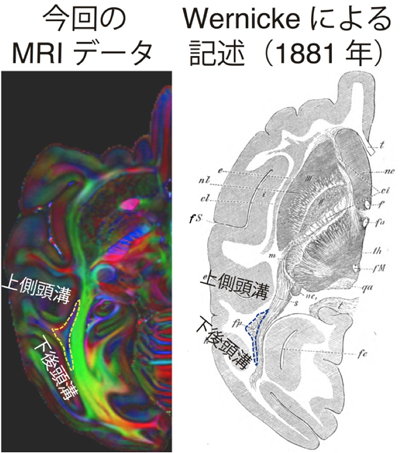 図2 サルのVertical Occipital Fasciculus