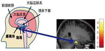 図　扁桃体と海馬の位置（左）と経済的不平等に対する活動パターン（右）