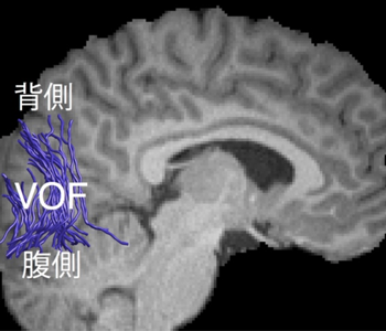 図2左: 拡散強調MRIによって計測されたVOF（青線）の例
