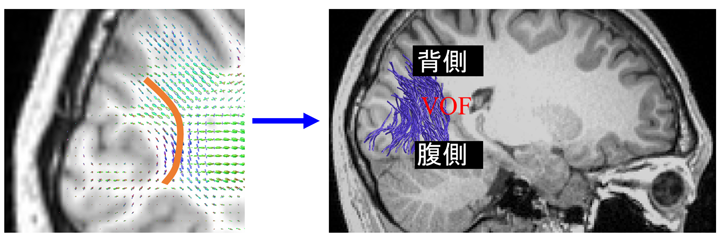 図6左: ヒトの脳から計測された拡散強調MRIデータの例　図6右: トラクトグラフィーの例