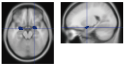 図2　扁桃体の位置　上側、横側から見たMRI像
