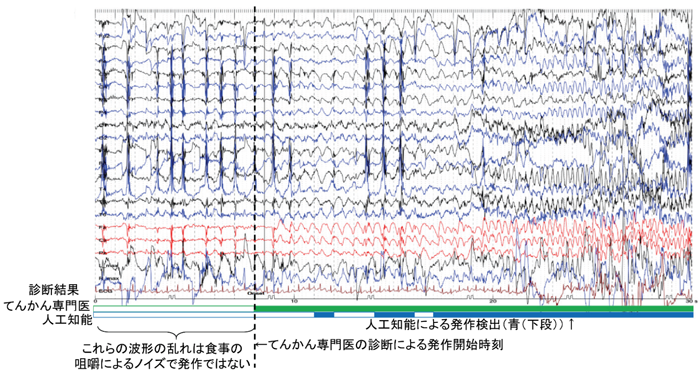 図2　てんかん発作の検出例